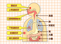 お医者さんに聞きました 教えて！子どもの食物アレルギー 図1